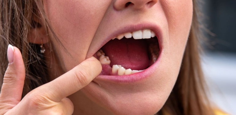 Belçika’da kadın çalışan dişleri nedeniyle ilk iş gününde işten çıkarıldı