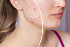 sivilceye-ne-iyi-gelir,-ergenlik-sivilceleri-nasil-gecer?-sivilce-neden-olur,-evde-sivilce-tedavisi-nedir-ve-nasil-yapilir?