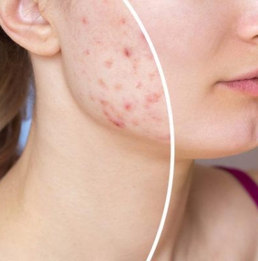 sivilceye-ne-iyi-gelir,-ergenlik-sivilceleri-nasil-gecer?-sivilce-neden-olur,-evde-sivilce-tedavisi-nedir-ve-nasil-yapilir?