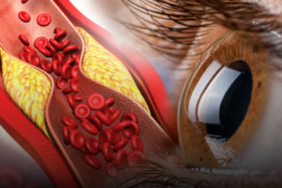 gozlerde-ortaya-cikan-bu-duruma-dikkat!-yuksek-kolesterolun-bilinmeyen-isareti