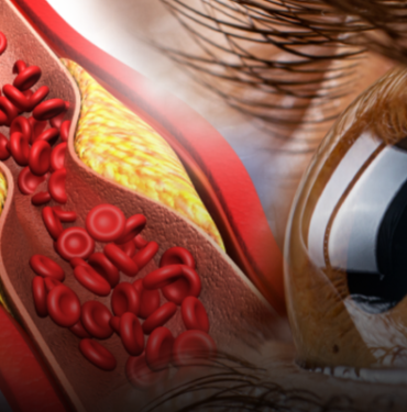 gozlerde-ortaya-cikan-bu-duruma-dikkat!-yuksek-kolesterolun-bilinmeyen-isareti