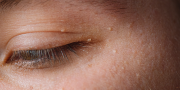 turk-arastirmacilar-buldu!-diyabetin-ciltteki-bilinmeyen-belirtisi…-hemen-kontrol-edin!