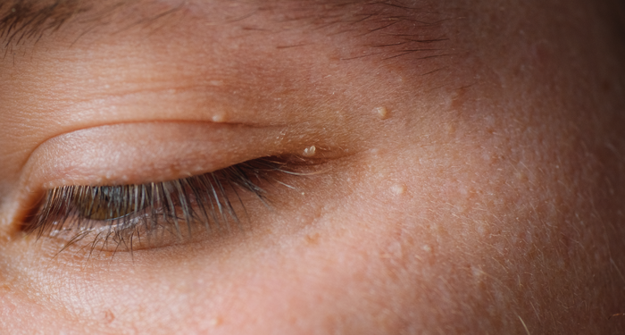 turk-arastirmacilar-buldu!-diyabetin-ciltteki-bilinmeyen-belirtisi…-hemen-kontrol-edin!