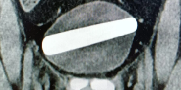 vajinasi-yerine-uretrasina-soktugu-seks-oyuncagi-hastanelik-etti!-hemen-ameliyata-alindi…