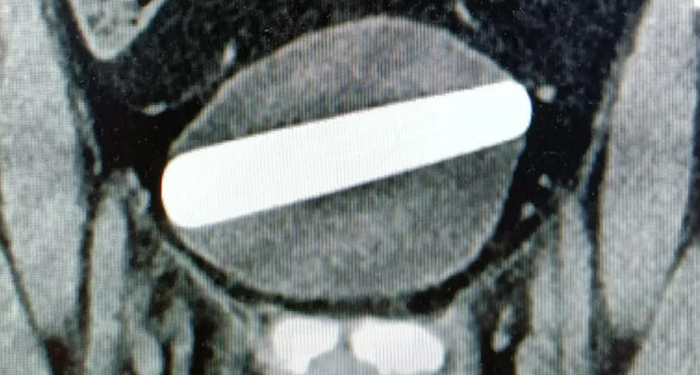 vajinasi-yerine-uretrasina-soktugu-seks-oyuncagi-hastanelik-etti!-hemen-ameliyata-alindi…