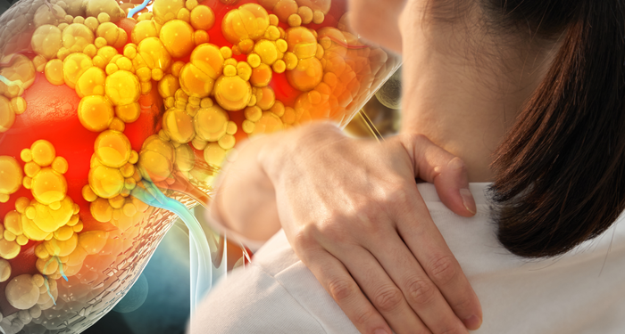 Karaciğerin bittiğini gösteren işarete dikkat! Hastaların yüzde 82’si aynı belirtiyi yaşıyor