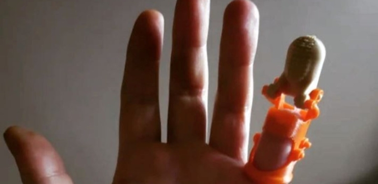 Kopan parmağına 20 yıl sonra 3 boyutlu yazıcıyla kavuştu