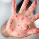 salgin-kizamik-hastaligina-dikkat!-vakalar-giderek-artiyor…-“bir-an-once-ciddi-tedbirler-alinmali!”