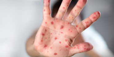 salgin-kizamik-hastaligina-dikkat!-vakalar-giderek-artiyor…-“bir-an-once-ciddi-tedbirler-alinmali!”