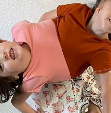 doktorlarin-yasamaz-dedigi-yapisik-ikizler-hayata-tutundu!-tek-bedende-iki-farkli-karakter