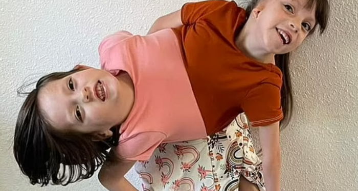 Doktorların yaşamaz dediği yapışık ikizler hayata tutundu! Tek bedende iki farklı karakter